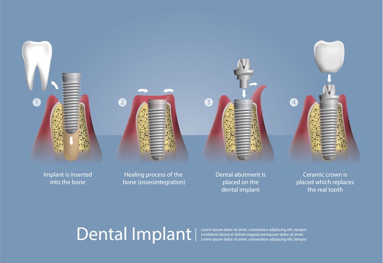 Dental Implant Process 