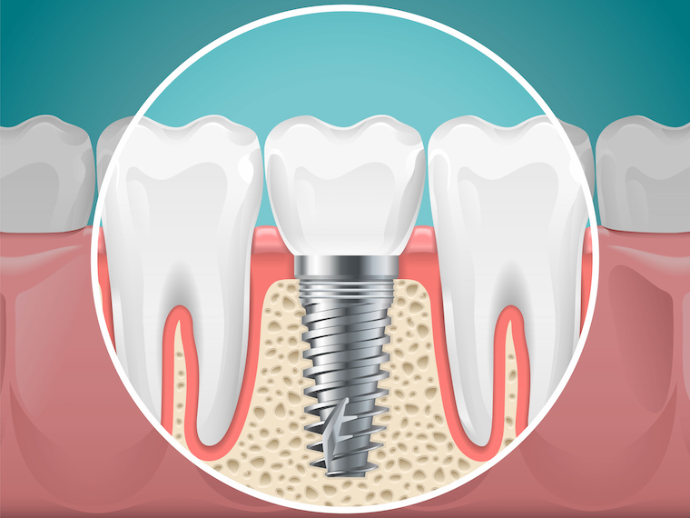 Dental Implants in Upper Marlboro MD Westphalia Dental