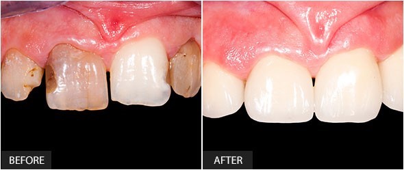 Image of before a crown placement, of damaged, dark, uneven teeth - placed next to a photo after crown placement, showcasing a bright, even row of teeth. 