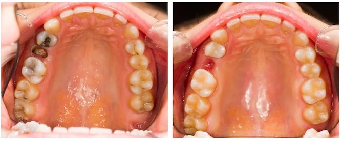 Image of before and after extraction of a tooth