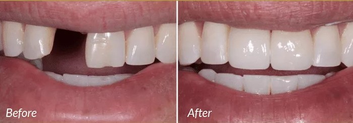 Image of before and after an implant is placed