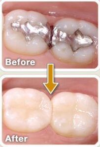 Image of before and after a white resin filling
